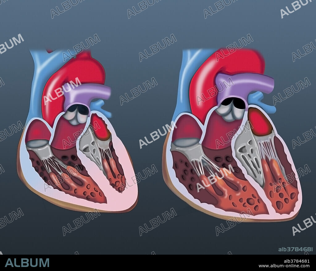 Medical illustration comparing the normal heart on the left with the heart pathology on the right: dilated cardiomyopathy.