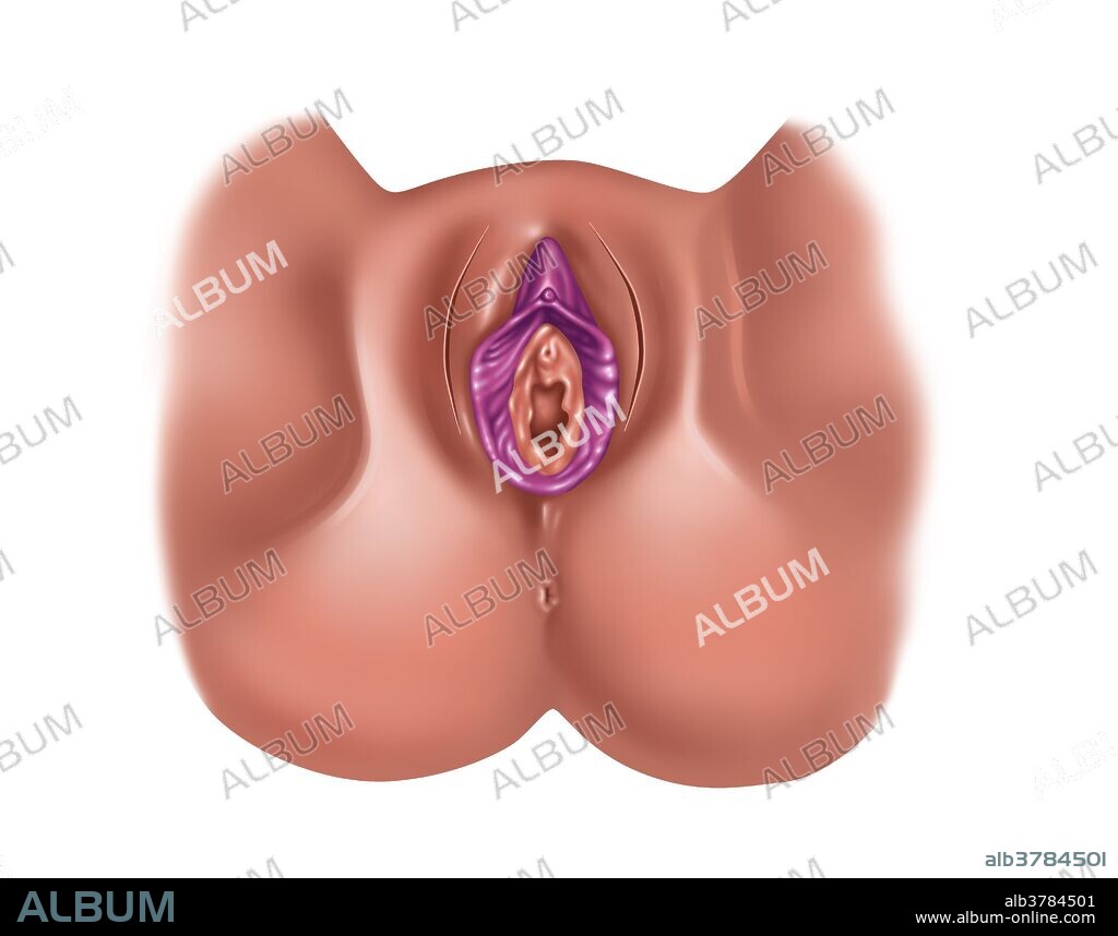 Illustration of total excision of the clitoris and labia minora. One of various methods of ritual removal of some or all of the female genitalia. These procedures are performed by a traditional circumciser using a blade or razor, with or without anesthesia. Female genital mutilation has been outlawed or restricted in most of the countries in which it occurs. It is rarely done as a therapeutic medical procedure, such as when cancer has developed in or spread to the clitoris.