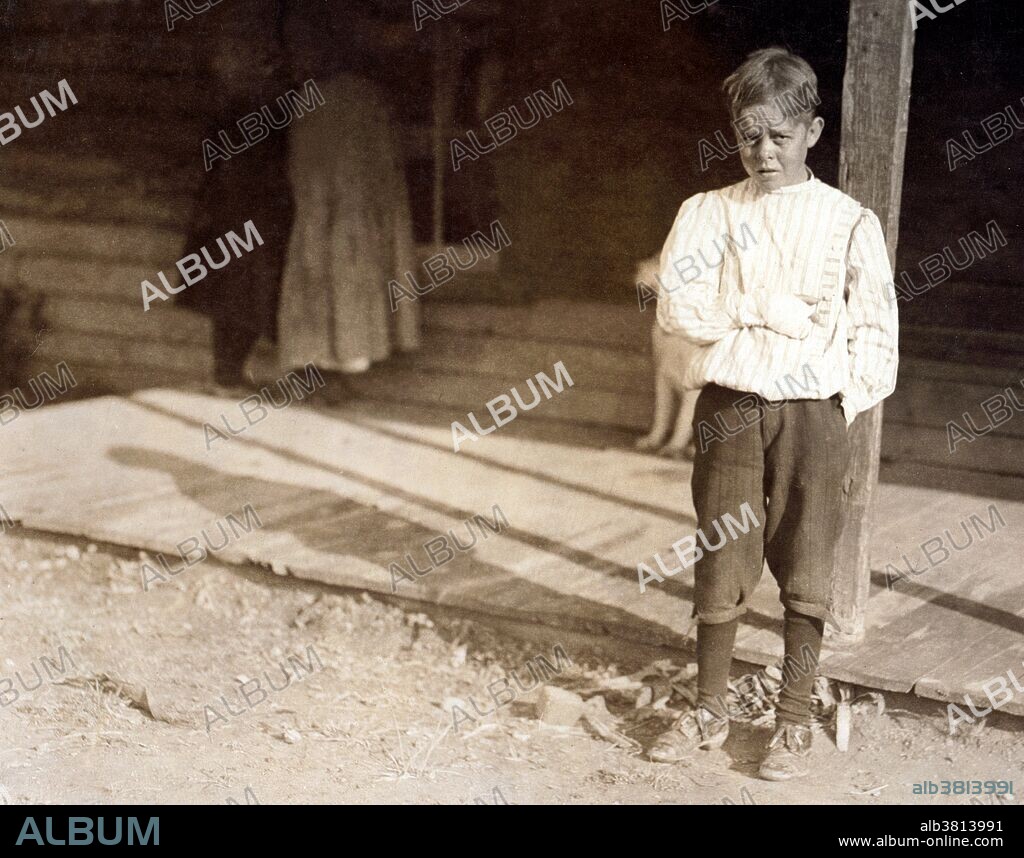 Entitled: "Accident to young cotton mill worker, Giles Edmund Newsom. While working in Sanders Spinning Mill, a piece of the machine fell on to his foot mashing his toe. This caused him to fall on to a spinning machine and his hand went into unprotected gearing, crushing and tearing out two fingers. He told the Attorney he was 11 years old when it happened. His parents are now trying to make him 13 years old. The school census taken at the time of the accident makes him12 years and school records say the same. His brother is not yet 11 years old. Both of the boys worked in the mill several months before the accident. His father, tried to compromise with the Company when he found the boy would receive money and not the parents. The mother tried to blame the boys for getting jobs on their own hook, but she let them work several months. The aunt said "Now he's jes got to where he could be of some help to his ma an' then this happens and he can't never work no more like he oughter." Location: Bessemer City, North Carolina." Photographed by Lewis Hine, October 23, 1912.