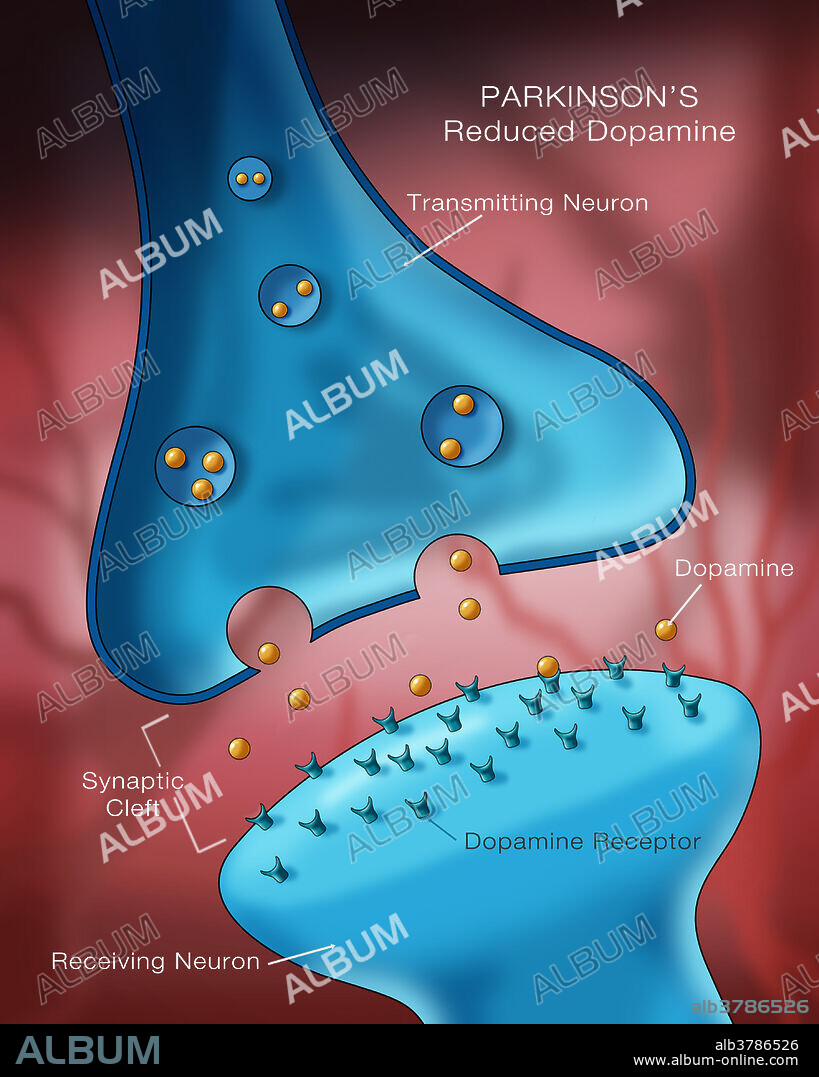 Labelled illustration showing low levels of the neurotransmitter dopamine in a neuron affected by Parkinson's disease.