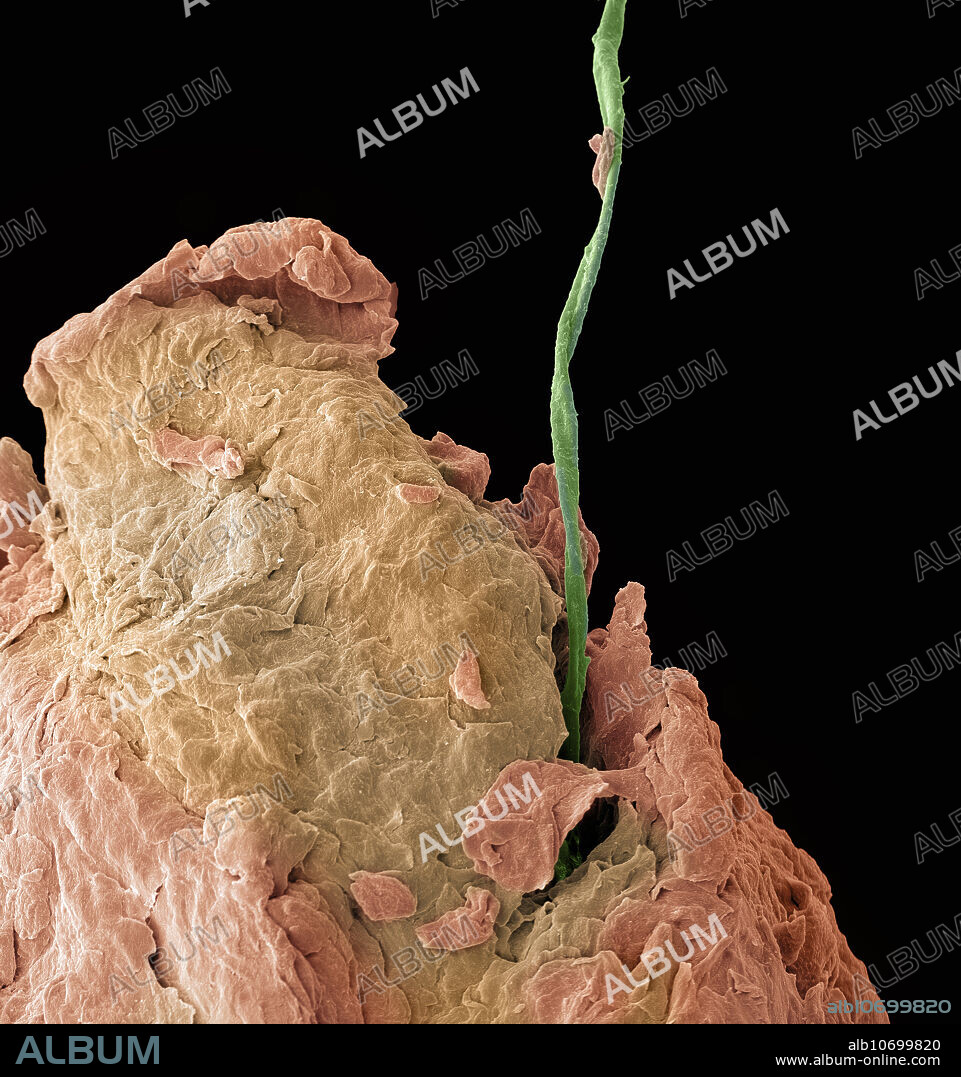 Colour enhanced scanning electron microscope image of Athlete's foot fungus. The field of view of this image is.4 mm or 400 um. Athlete's foot, known medically as tinea pedis, is a common skin infection of the feet caused by fungus. Signs and symptoms often include itching, scaling, and redness. Athlete's foot fungus often grows between the toes. It is a member of the group of diseases known as tinea.