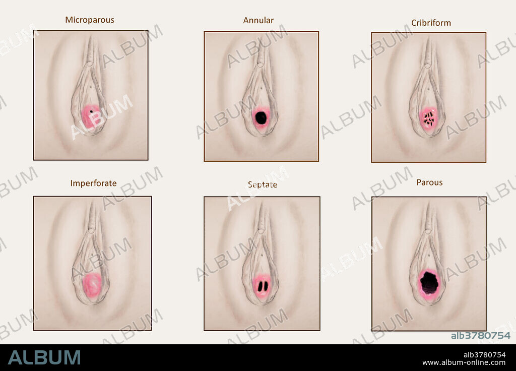Illustration showing varying types of hymens. The most common is form is not shown here. As with other structures of the genitals, the appearance of the hymen varies enormously and is sometimes completely lacking.