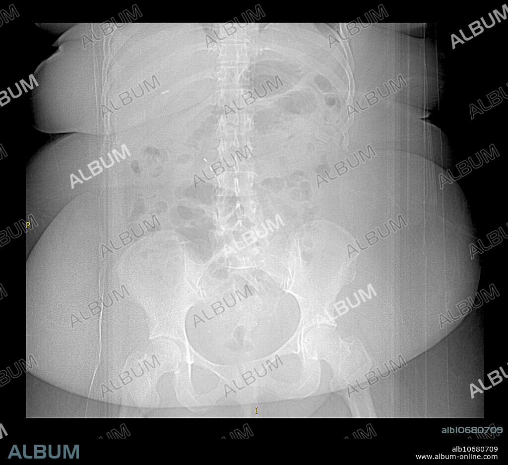 This frontal X-ray of a person with morbid obesity shows the extensive redundancy of skin folds and fat deposition. The difficulty in seeing the underlying bones is related to the attenuation of the X-ray beam from the excess soft tissue.