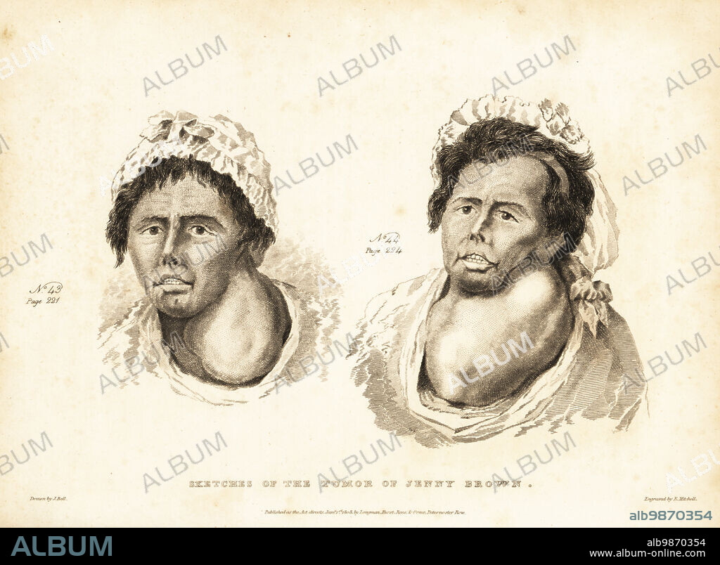 Growth of a neck tumor or "wen" of a poor farm labourer and out servant. No 43 before an inept operation. No 44 when it had grown so large to restrict breathing and swallowing. Sketches of the tumor of Jenny Brown. Copperplate engraving by Edward Mitchell after an illustration by John Bell from his own Principles of Surgery, as they Relate to Wounds, Ulcers and Fistulas, Longman, Hurst, Rees, Orme and Brown, London, 1815.
