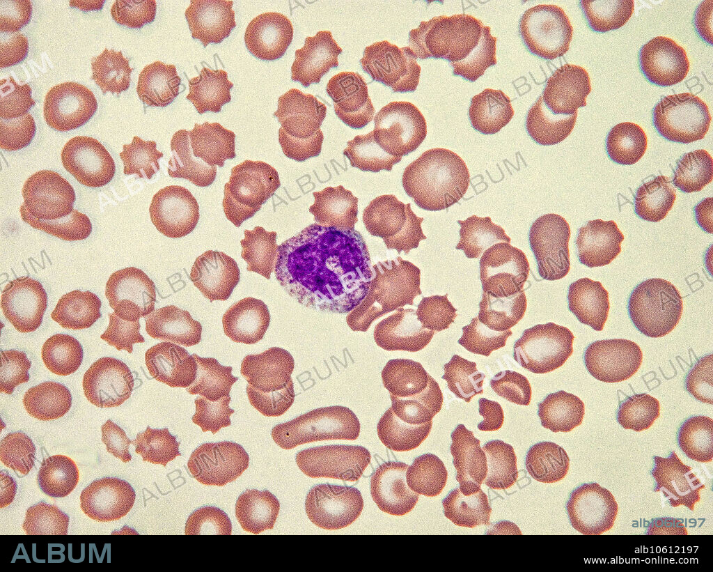 Toxic granulation in neutrophils is found in inflammatory states. The toxic granules are azurophilic, and may be found in the promyelocyte, metamyeloccyte, band (as shown here), and mature stages. Light micrograph, Wright-Giemsa stain. Magnification: 100x.