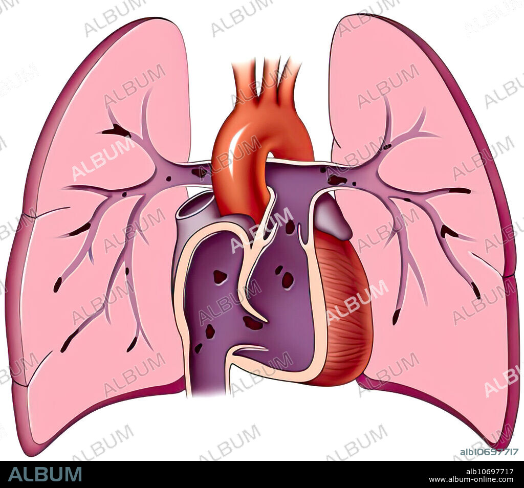 Pulmonary emboli shower, illustration. Heart and lungs in coronal section showing an embolic shower/pulmonary emboli, may be fatal if the shower is extensive enough.