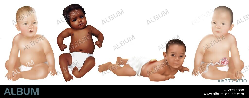 An illustration of 4 common birth defects found in babies. Cleft palate, clubfoot, spina bifida and gastroschisis. 1 baby in 30 is born with one or more major birth defects. Most are correctable with modern surgery.