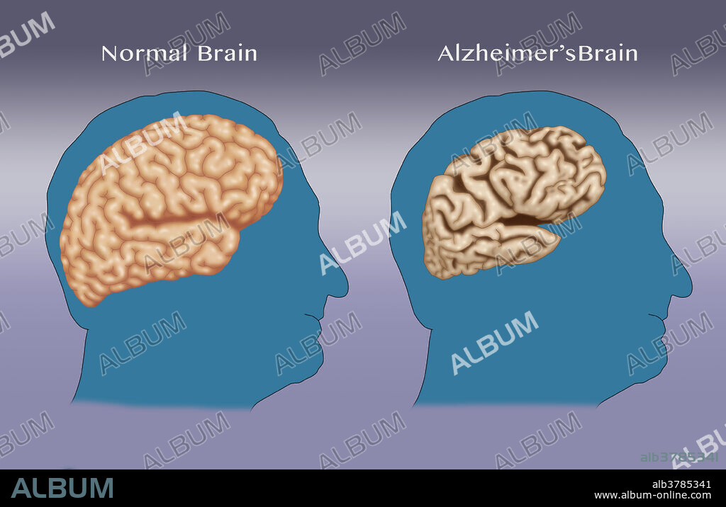 Illustration comparing a normal brain (left) with a brain suffering from Alzheimer's disease (right).