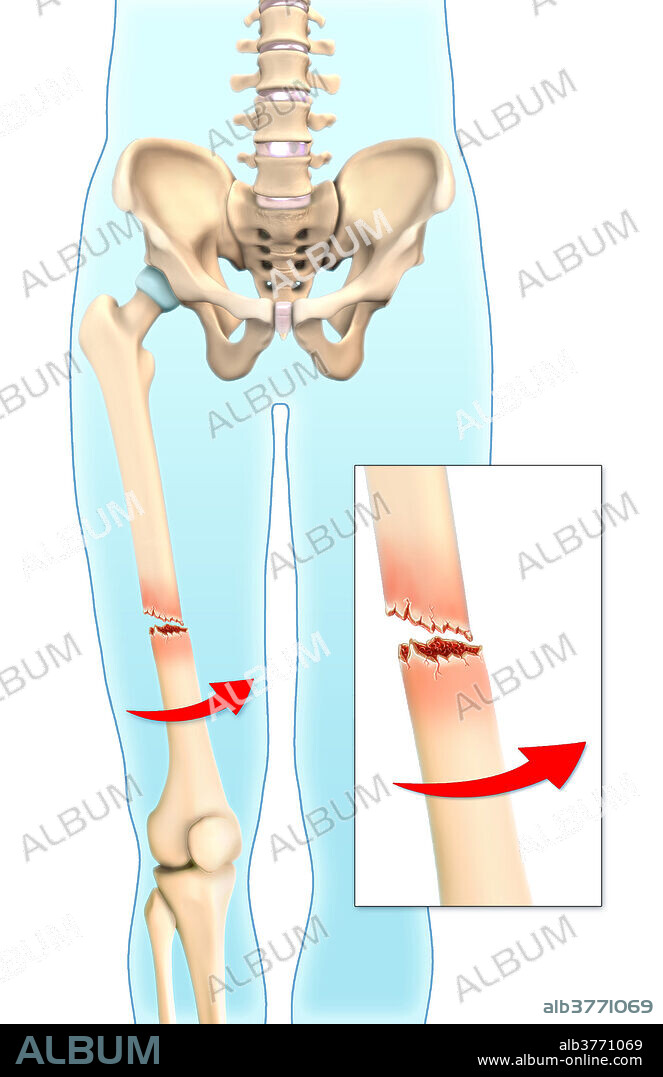 An illustration of a spiral fracture in which part of the bone has been twisted.