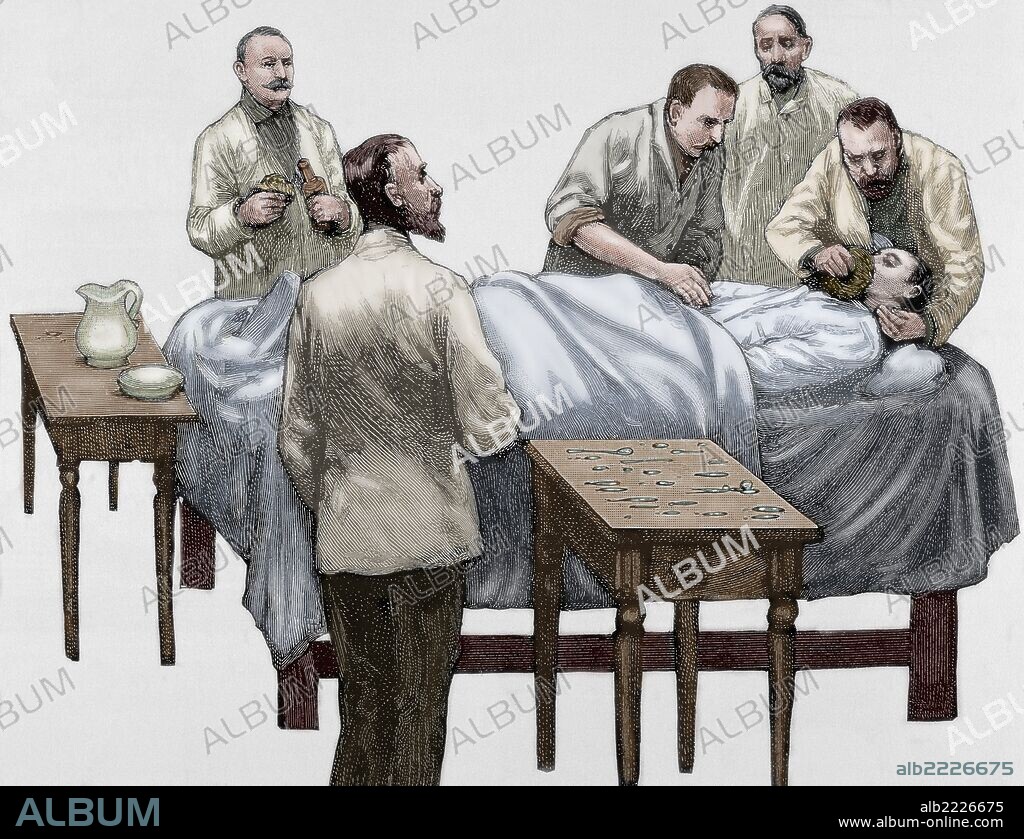 HISTORIA DE LA MEDICINA. ANESTESIA mediante CLOROFORMO, producto que se empezó a utilizar como anestésico general en el año 1847. Grabado coloreado del siglo XIX.