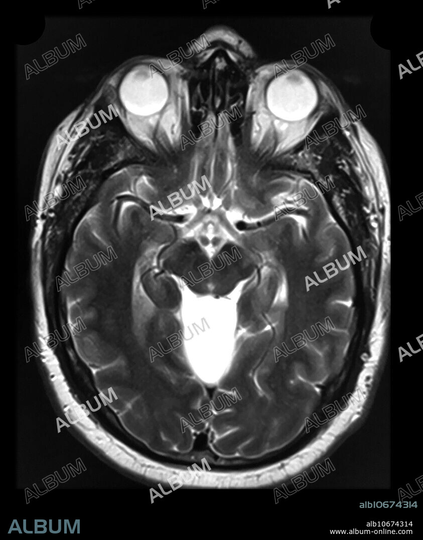 This axial (cross sectional) T2 weighted MR image of the brain shows a large arachnoid cyst in the supracerebellar cistern with prominent associated mass effect upon the superior cerebellum.