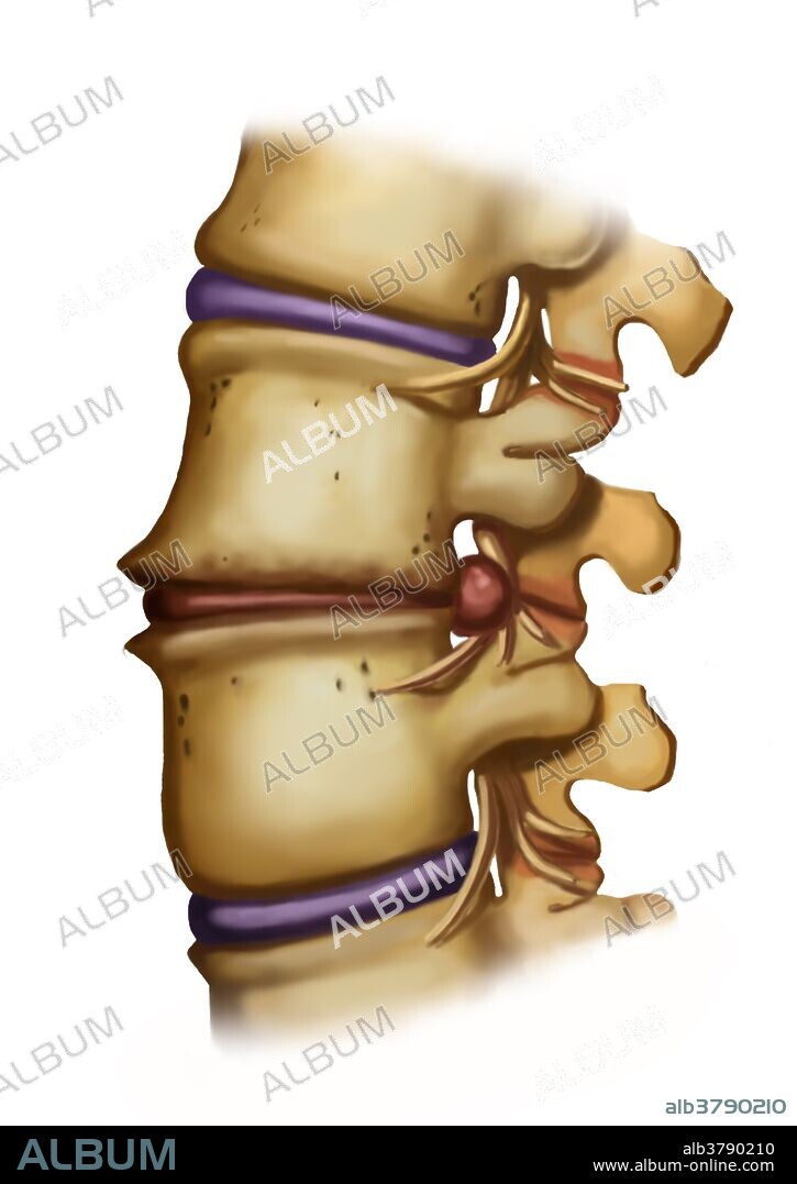 Illustration of spondylosis of the lumbar vertebrae (lumbar arthrosis), with discarthrosis, herniated disc (red disc at center) and facet arthrosis. Spondylosis is a non-inflammatory degeneration (arthrosis) of the vertebral column. It can be accompanied, as shown here, by discarthrosis (arthrosis of intervertebral disks), facet arthrosis (arthrosis of the vertebral apophyses), formation of osteophytes (bone spurs) or a compression of the spinal cord or the nerve roots.
