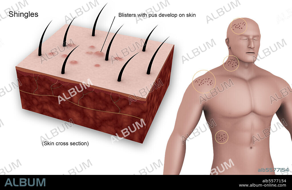 Medical diagram showing shingles caused by the varicella-zoster virus.