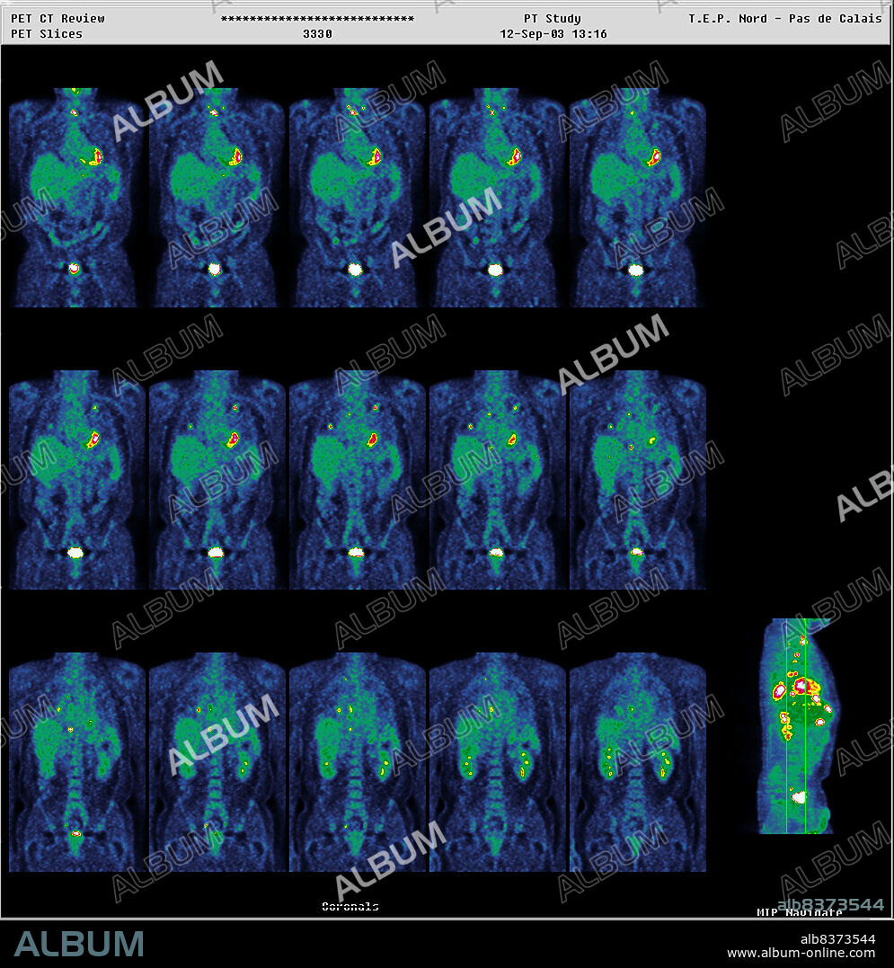 Institute of Nuclear Medicine, University Hospital of Lille, France. PET Scan (Positron emission tomography).. Colorectal carcinoma. Several liver and lung abnormalities which contra-indicate surgical intervention.