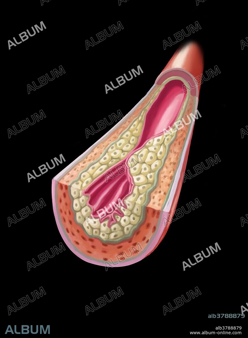 A clogged artery or Atherosclerosis (arteriosclerotic vascular disease - ASVD) is when the artery walls thicken due to the buildup of cholesterol. The accumulation of multiple plaques can lead to strokes and cardiac arrest often without any prior symptoms.