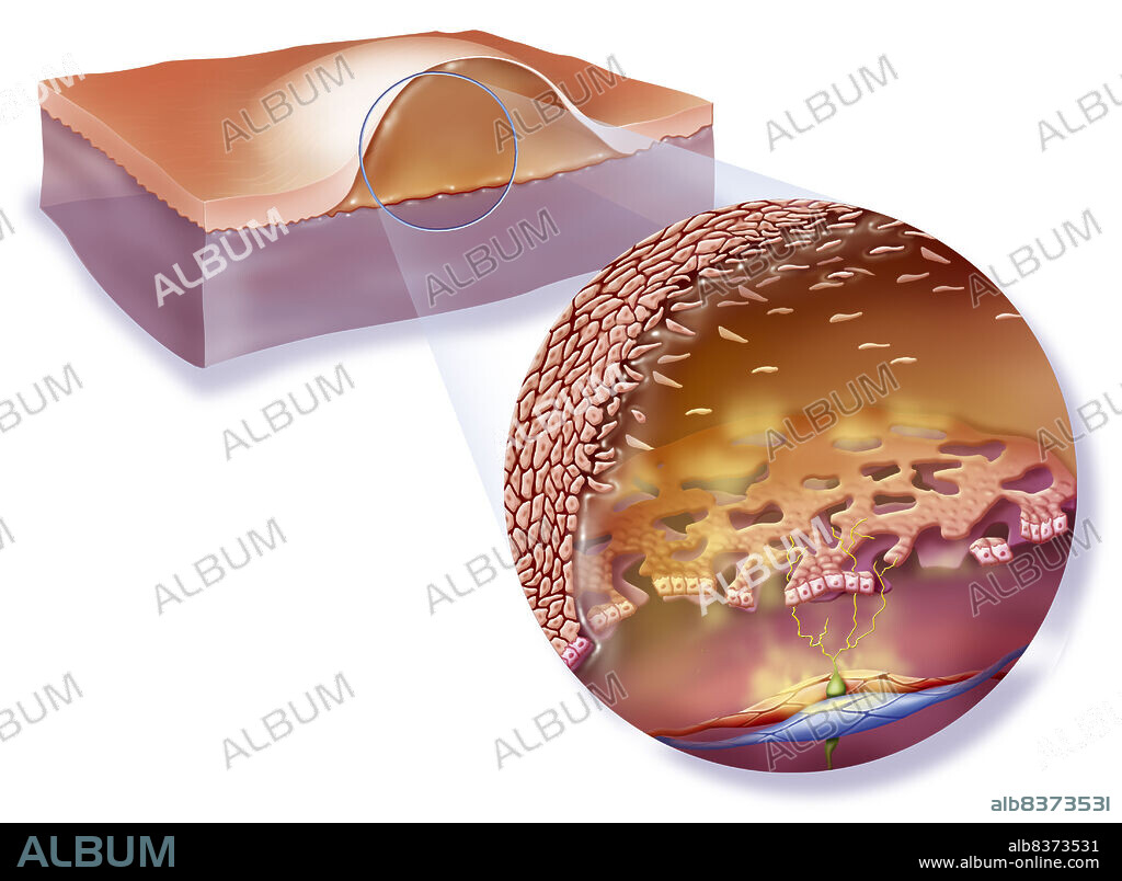 Blister.. Illustration of a blister. A plasma-filled bubble has formed under the skin due to a second-degree burn, with destruction of keratinocytes down to the stratum germinativum.