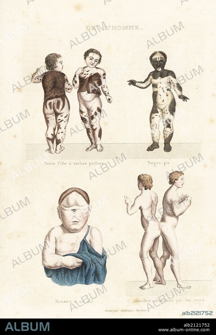Young girl with hirsutism, boy with vitiligo, child with one eye, conjoined twins. Handcoloured engraving on steel by Ambroise Tardieu from Richard's "New Edition of the Complete Works of Buffon," Pourrat Freres, Paris, 1837.