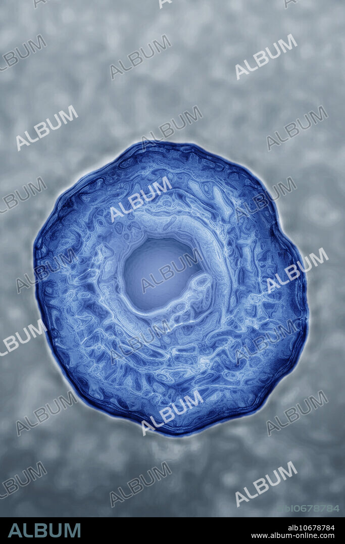 Colorized transmission electron micrograph (TEM) of Herpes Simplex Virus (HSV1 and HSV 2). HSV1 causes infections of the nose, mouth and face, and HSV2, which infects the genitals. There is no cure for herpes simplex infection, but outbreaks can be treated with the antiviral drug acyclovir. Magnification 500,000 X at 10 cm. Viral diameter approximately: 200 nm.