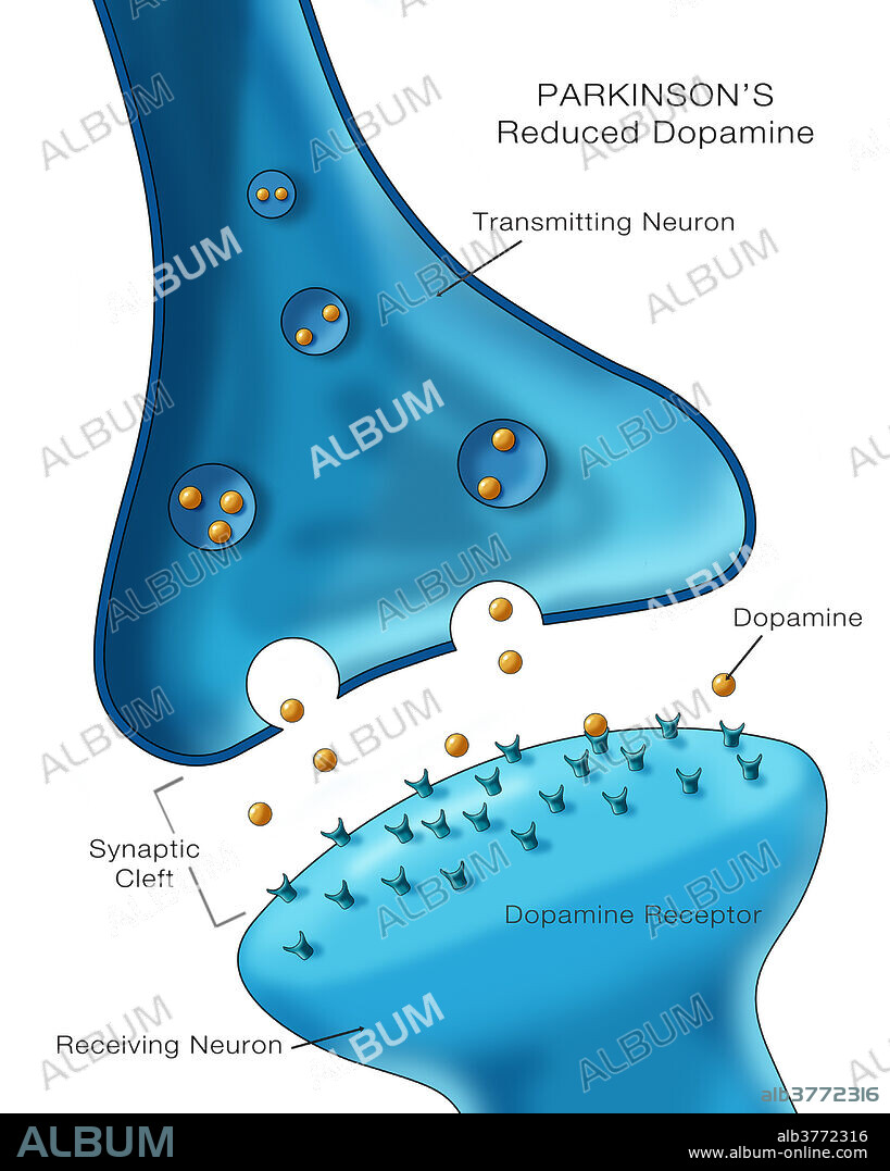 Labelled illustration showing low levels of the neurotransmitter dopamine in a neuron affected by Parkinson's disease.