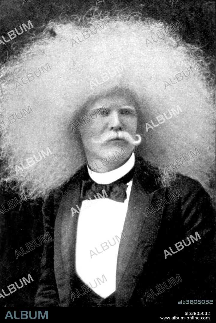 Unzie, an albino Aborigine man with an abundance of white hair. Albinism is a congenital disorder characterized by the complete or partial absence of pigment in the skin, hair and eyes due to absence or defect of tyrosinase, a copper-containing enzyme involved in the production of melanin. Albinism results from inheritance of recessive gene alleles and is known to affect all vertebrates, including humans. Albinism is associated with a number of vision defects, such as photophobia, nystagmus and astigmatism. Lack of skin pigmentation makes for more susceptibility to sunburn and skin cancer. Reproduction by Sedgwick after a photograph by Wendt, late 19th century.