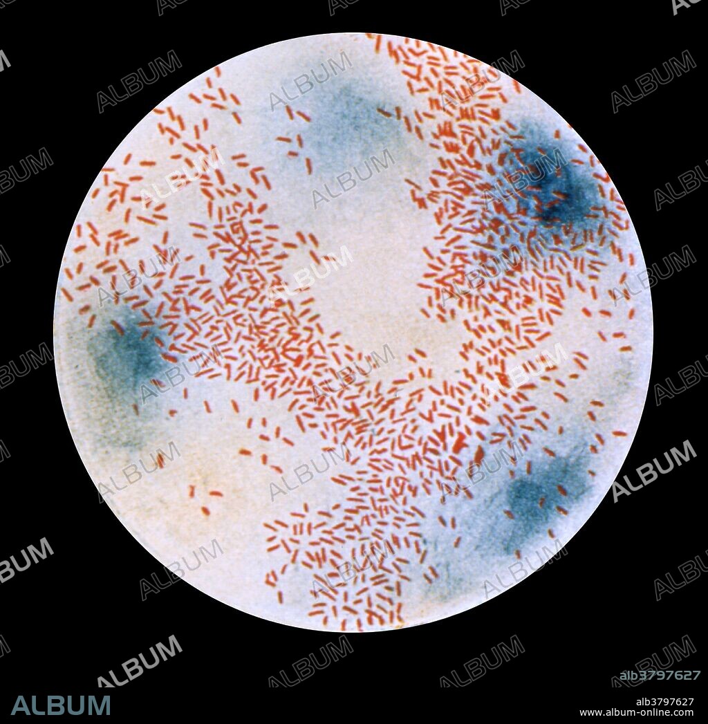 Photomicrograph of Haemophilus influenzae as seen using a Gram-stain technique. Haemophilus influenzae, formerly called Pfeiffer's bacillus or Bacillus influenzae, is a Gram-negative, rod-shaped bacterium first described in 1892 by Richard Pfeiffer during an influenza pandemic. A member of the Pasteurellaceae family, it is generally aerobic, but can grow as a facultative anaerobe.