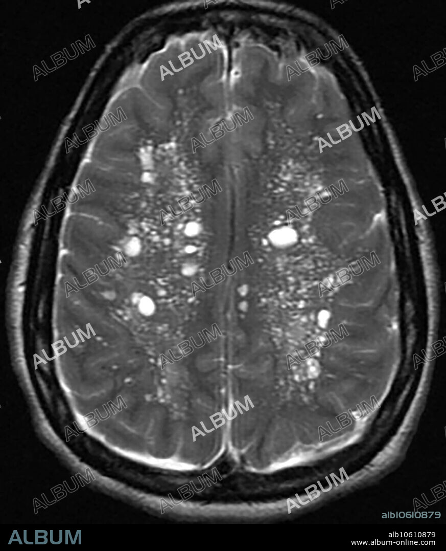 This axial (cross sectional) T2 weighted MR image of an elderly subject demonstrates multiple prominent perivascular spaces (Virchow-Robin Spaces). Visualization of perivascular spaces is a normal finding and when it is very prominent can be confused with a pathologic (abnormal) state.