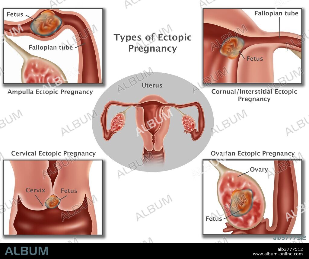 Illustration of common ectopic pregnancies. Pregnancies occurring in the Ampulla (top left), Interstitial Fallopian Tube (top right), cervix (bottom left), and the ovary (bottom right). As the ectopic pregnancy develops, the growing embryo may rupture the surrounding tissues causing serious bleeding. Surgery is usually performed to remove the embryo, and to repair or remove the area of implantation.