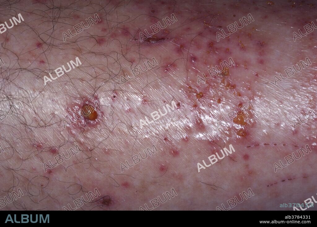 Lower leg covered in poison ivy rash and developing puss.