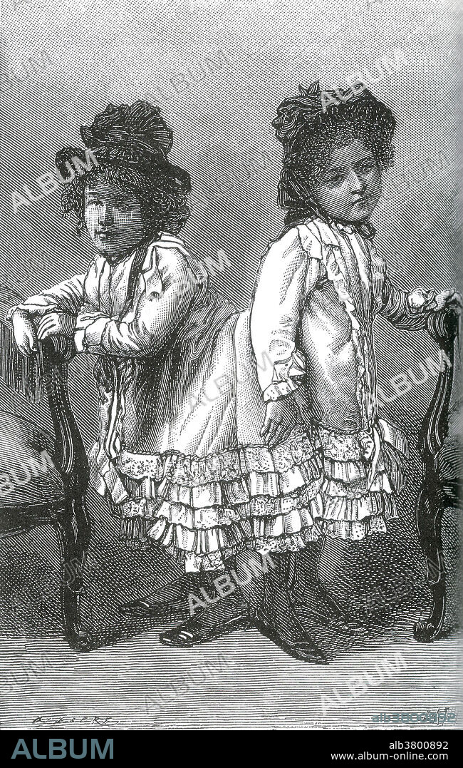 Rosa and Josefa Blazek were pygopagus twins born in Bohemia (modern-day Czech Republic) on January 20, 1878. They shared tissue and cartilage but were also joined at a thoracic vertebra. It was that delicate fusion that negated any possibility of separation and when their mother took them to Paris at the age of thirteen, doctors told her just that. It was in Paris were the twins began their career in professional exhibition. The Blazek sisters were famous in the 1890's as they toured Europe. They eventually become quite skilled on the violin and stunned crowds with their enthusiastic duets. But, by the turn of the twentieth century, their popularity quickly evaporated due to poor management and overexposure. Their obscurity was shattered in 1909 when Rosa claimed to be pregnant. She claimed she had only had intercourse once and she refused to name the father. Regardless of the paternity, a son, Franz, was born on April 16 1910. He eventually joined.