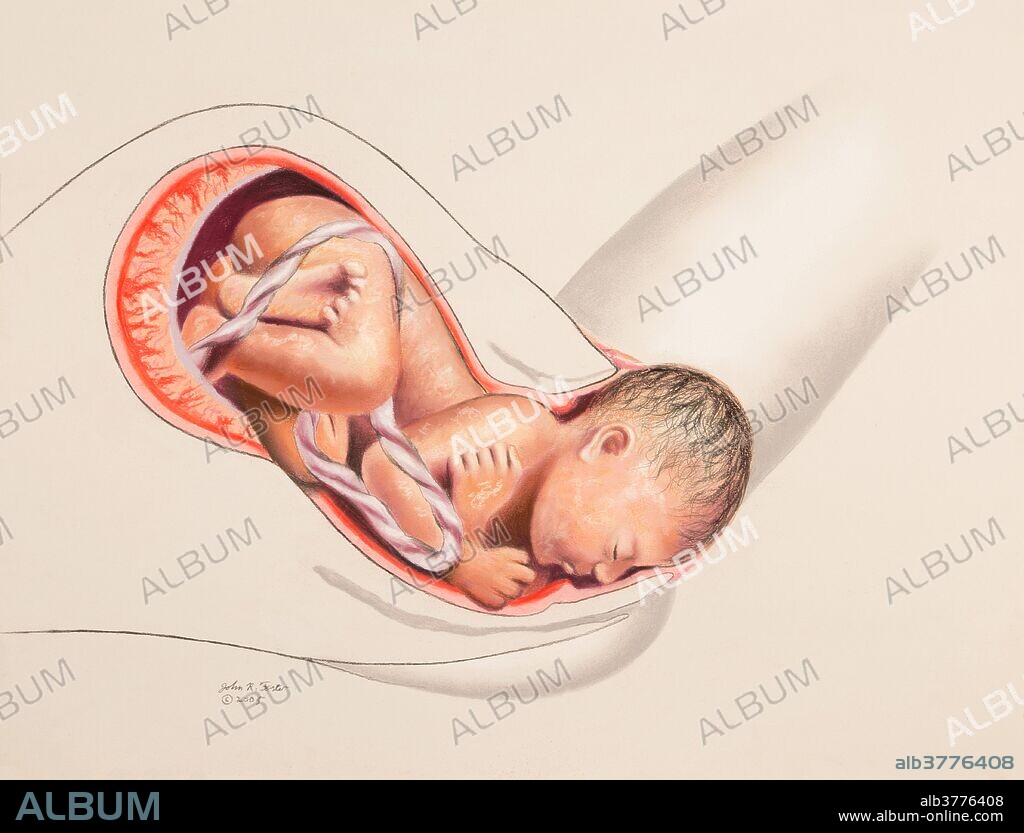 Illustration of the 2nd stage of childbirth. The baby is well into the vagina or birth canal and the head is being delivered. This is usually the most difficult part of the birth process for the mother. Image 2 of 5.
