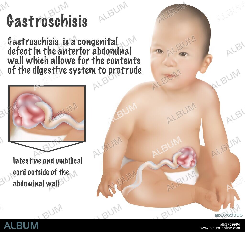 An illustration of a baby with Gastroschisis. Gastroschisis is a congenital defect in the anterior abdominal wall which allows for the contents of the digestive system to protrude. 1 baby in 30 is born with one or more major birth defects. Most are correctable with modern surgery.