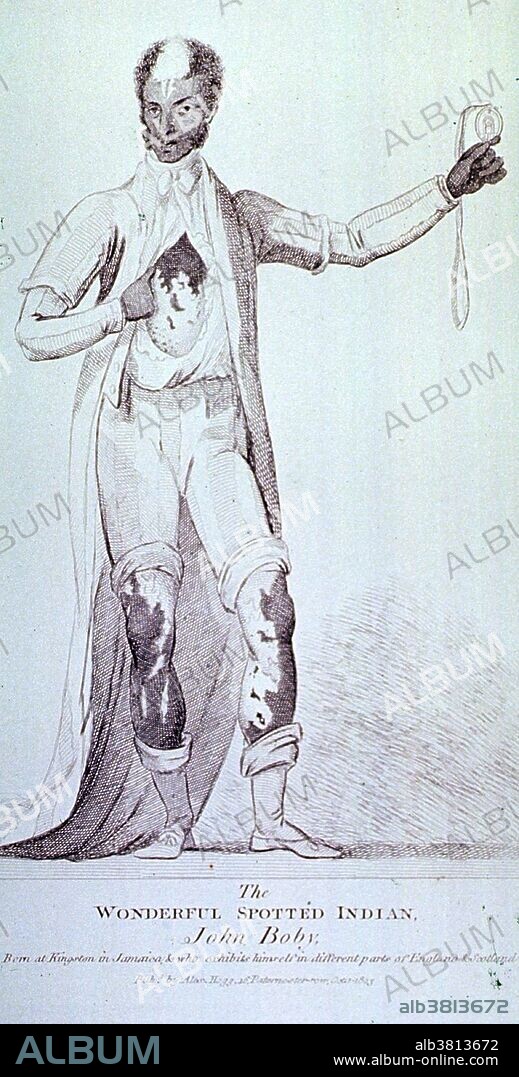 Engraving of John Body, the Wonderful Spotted Indian, who had vitiligo, a condition involving loss of pigmentation. John Boby was born in 1774 near Kingston, Jamaica, to slaves who already had four children. He had vitiligo, whereby the skin loses its pigment in random patches. His mother was so frightened when she saw white patches on the baby's black skin that she refused to suckle him. It is likely that she was terrified of being accused of adultery with a white man. The boy was sent to Liverpool at the age of 12 and christened John Primrose Richardson Boby. He was bought and exhibited by a showman named Clark and in 1795 was on display at London's famous Bartholomew Fair. His life turned out happily when hee gained his freedom and married an English woman.