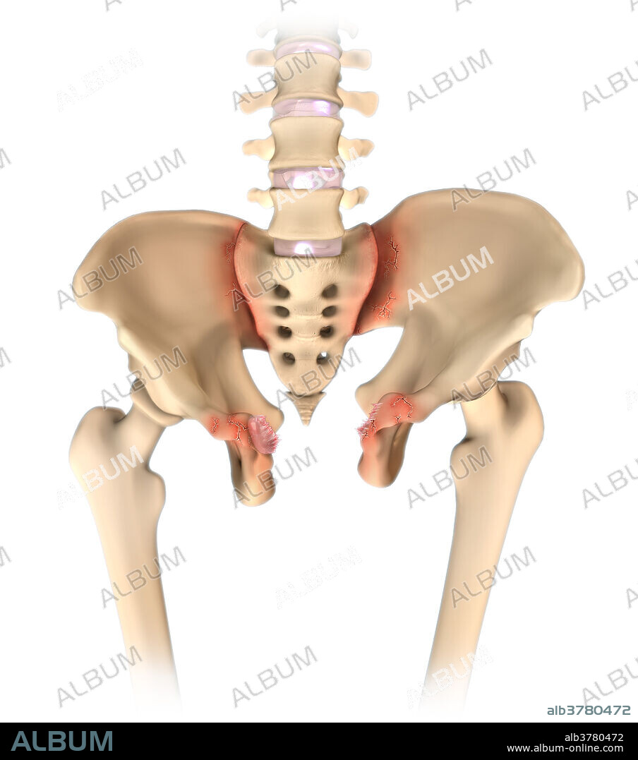 An illustration of a pelvic fracture resulting from a heavy impact to the groin (pubis), known as an open book fracture. This injury is typically seen in motorcycle accidents in which the left and right halfs of the pelvis separate at the front and rear, resembling an open book.