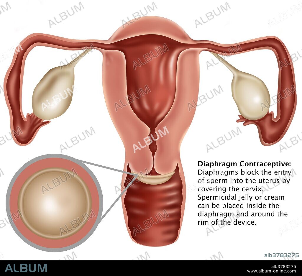 Illustration of a diaphragm contraceptive. Diaphragms block the entry of sperm into the uterus by covering the cervix. Spermicidal jelly or cream can be placed inside the diaphragm and around the rim of the device.