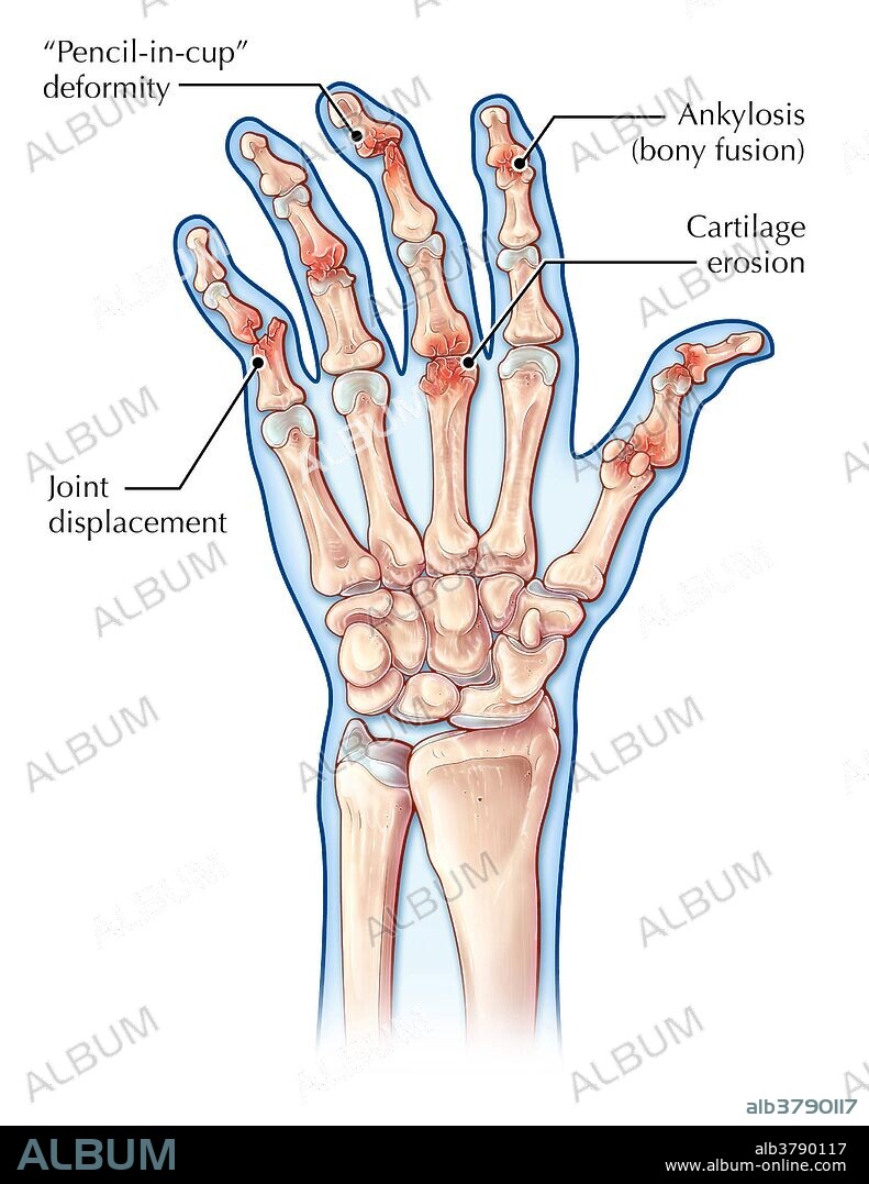 An illustration of joints affected by psoriatic arthritis, a chronic inflammatory skin condition (psoriasis) accompanied by arthritis and other joint problems. A "pencil-in-cup" deformity is a typical characteristic of psoriatic arthritis as bone begins wearing away due to prolonged damage. Other symptoms such as cartilage erosion, joint fusions or joint displacements may also occur.