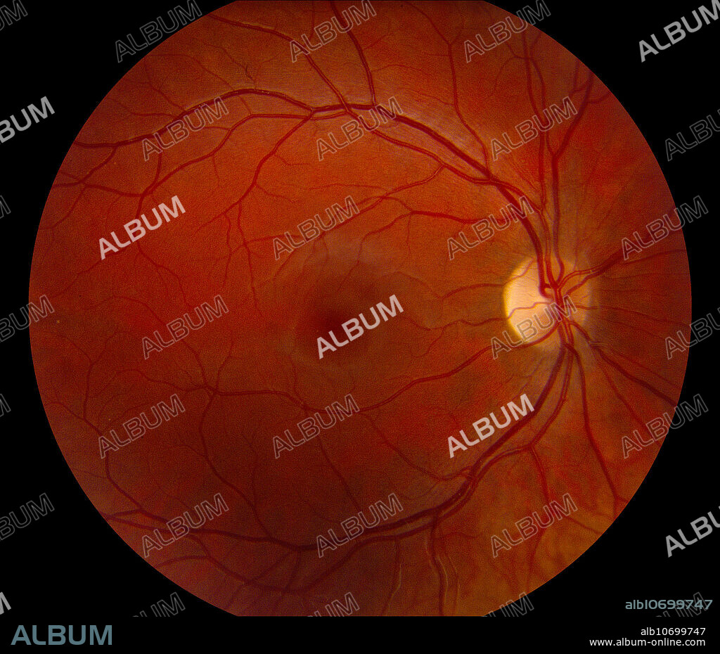Fundus photograph of normal optic disc (nerve), macular and retinal vessels of young woman.