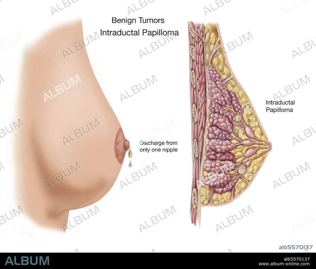 Benign intraductal papilloma on the female breast.