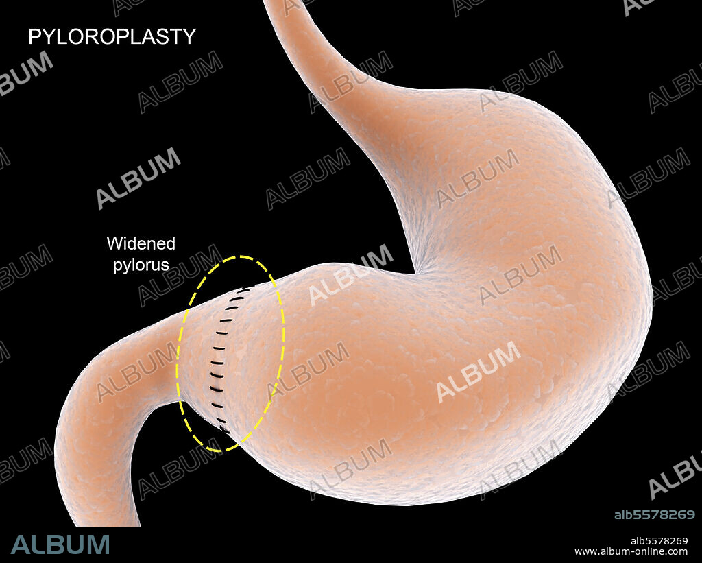 Medical illustration showing pyloroplasty, which widens the pylorus in stomach.