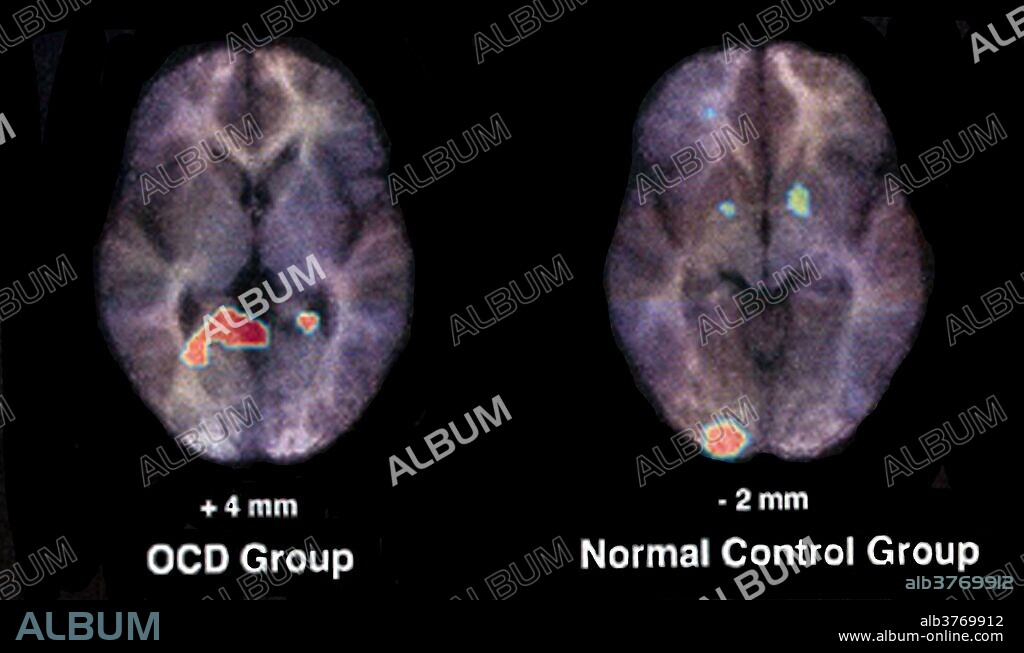 PET scan of normal brain acitivity (right) compared to OCD brain activity (left) when subjects performed the same cognitive task. Obsessive-compulsive disorder (OCD) is a mental disorder where people feel the need to check things repeatedly, perform certain routines repeatedly, or have certain thoughts repeatedly. People are unable to control either the thoughts or the activities. Common activities include hand washing, counting of things, and checking to see if a door is locked. Some may have difficulty throwing things out. These activities occur to such a degree that the person's daily life is negatively affected. Dated July 7, 2009.