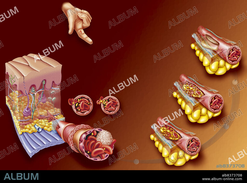 Coagulation.. When the skin is cut, a chain reaction is triggered to stop bleeding:. First, a vascular spasm, a contraction of the muscle fibers in the blood vessels, occurs to help bring the wound's edges closer together.. Then, the blood platelets form a haemostatic plug, reinforced with fibrin strands which also help emprison the red blood cells.. The wound hardens upon drying and shrinks, evacuating blood serum and bringing the wound's edges even closer together. This is known as the biological bandage.
