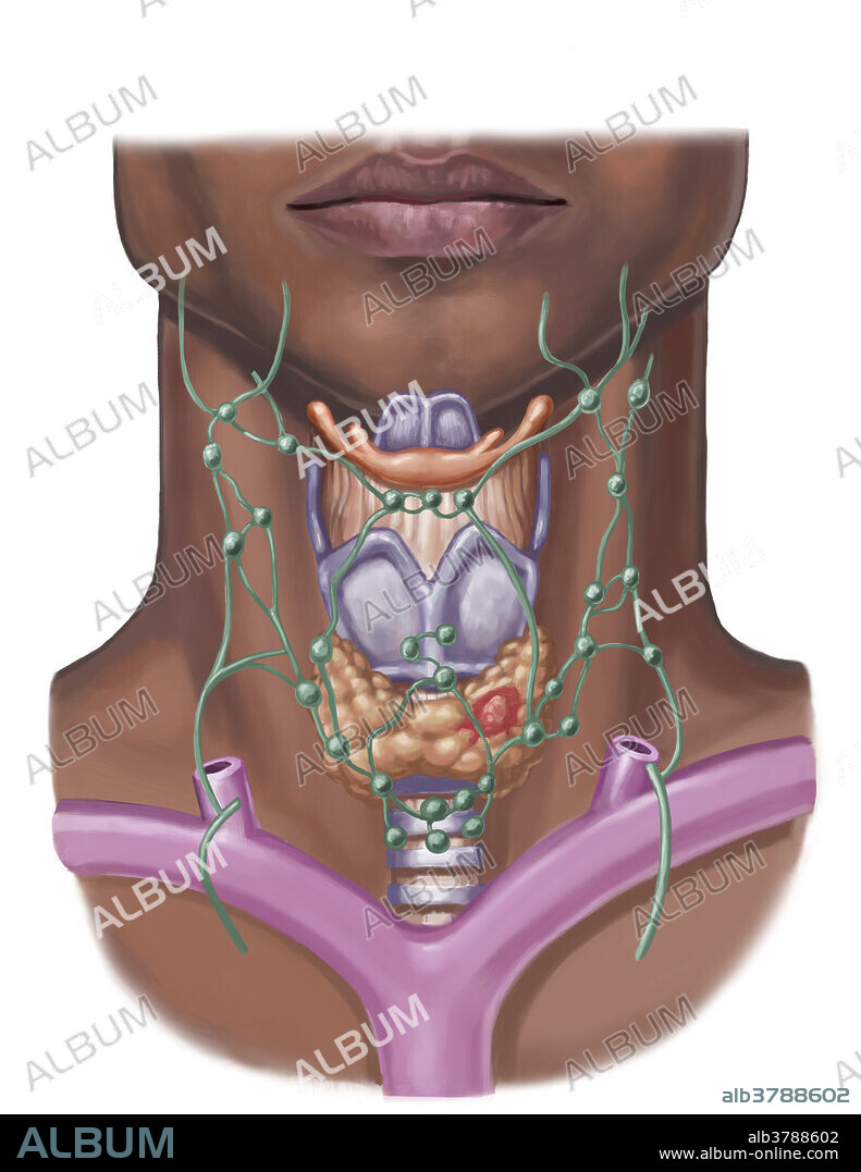 Illustration of a thyroid nodule (in red). These nodules mainly affect women and are mostly benign, but need to be watched.