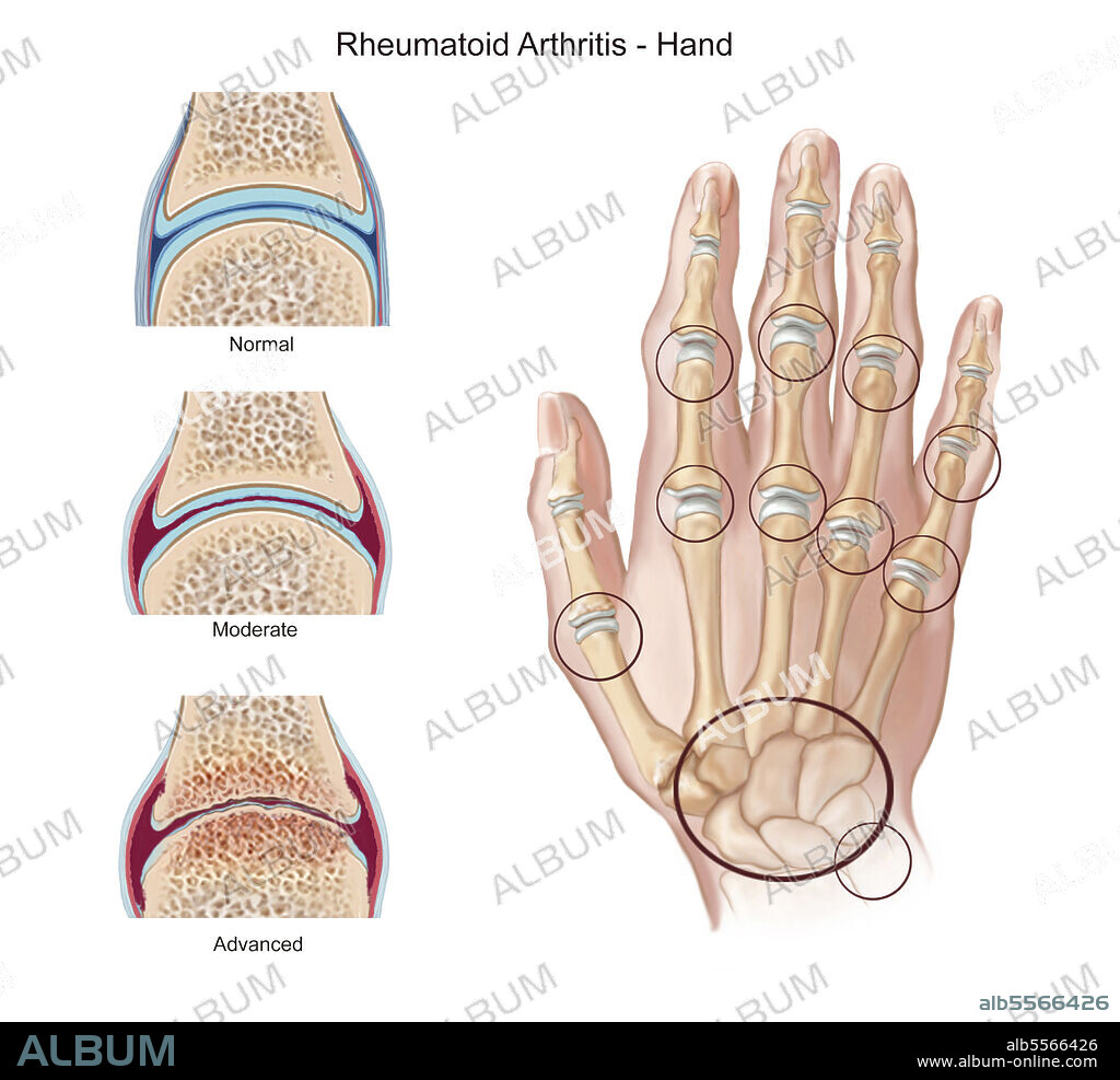 Stages of rheumatoid arthritis on hand, with highlight of joints involved.
