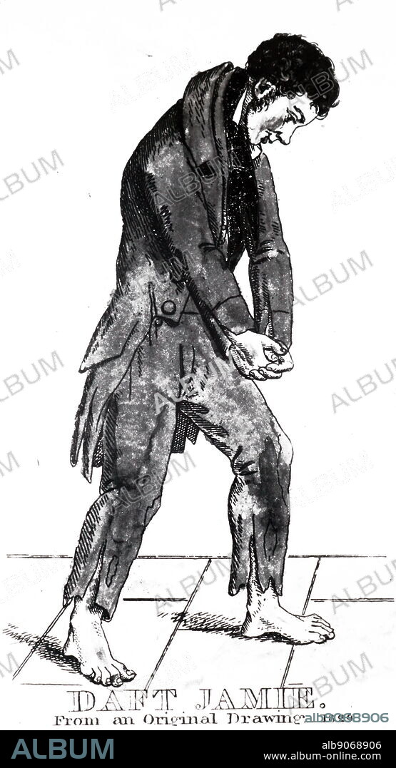 Daft Jamie (James Wilson) one of the victims of Burke and Hare, the body snatchers and murderers. They undertook to provide the Edinburgh Medical School with cadavers and they turned to murder as a scource of supply. Their activities led to the passing of the Anatomy Act of 1832.