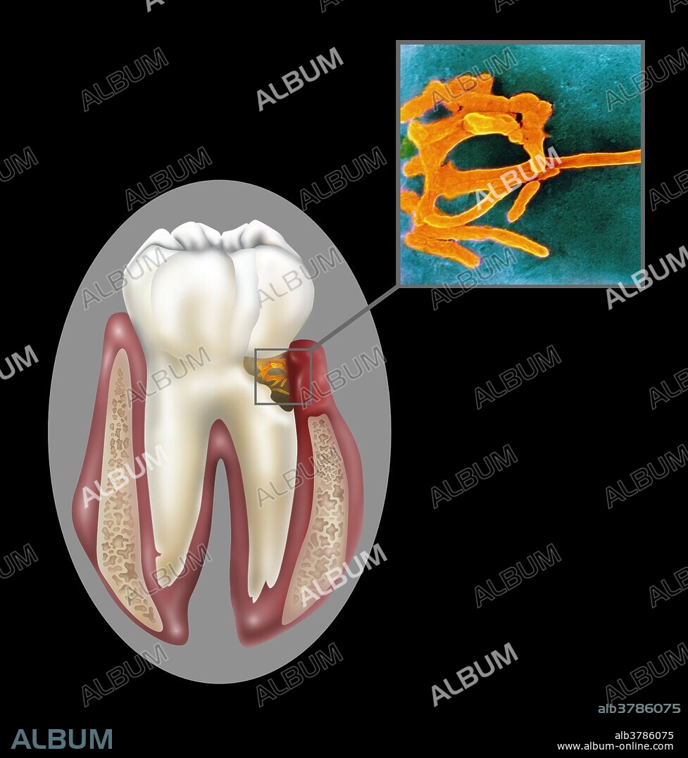 Fusobacterium nucleatum, oral bacteria found in the dental plaque of humans. Associated with the periodontal gum disease.