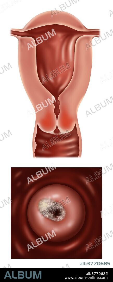 Medical illustration showing early stage IB of cervical cancer. This stage is defined by clinically visible lesions, less than 4 centimeters across the greatest dimension, limited to the cervix uteri. Symptoms of cervical cancer include bleeding between periods, pain after sexual intercourse and heavier periods. Cancer of the cervix is rare and if detected early is almost always cured.