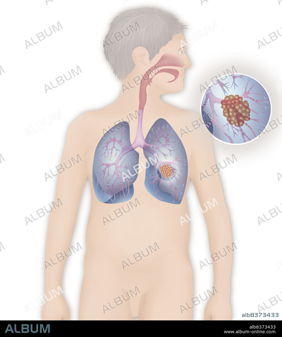 Depiction of a cancerous tumour in the left lung.