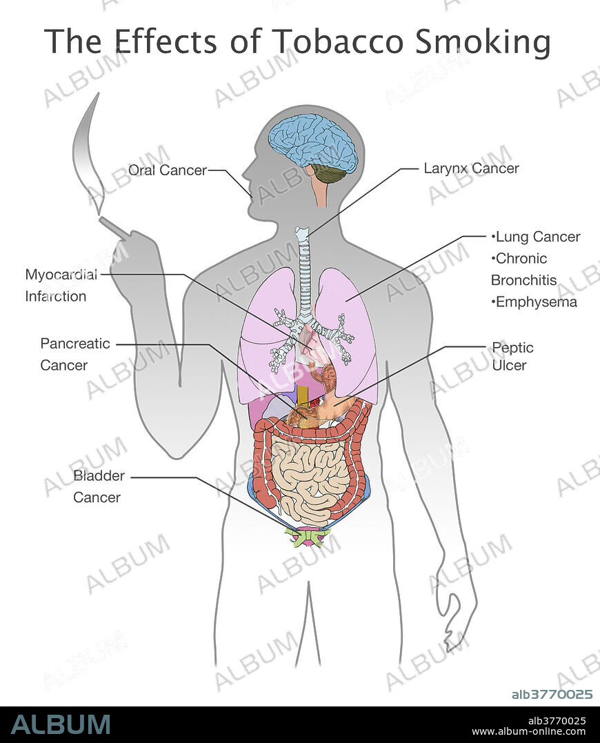 Illustration showing the wide range of adverse health effects that smoking tobacco can cause and their locations in the human body, including (clockwise from top left): oral cancer, laryngeal cancer, lung cancer, chronic bronchitis, emphysema, peptic ulcer, bladder cancer, pancreatic cancer, and myocardial infarction.