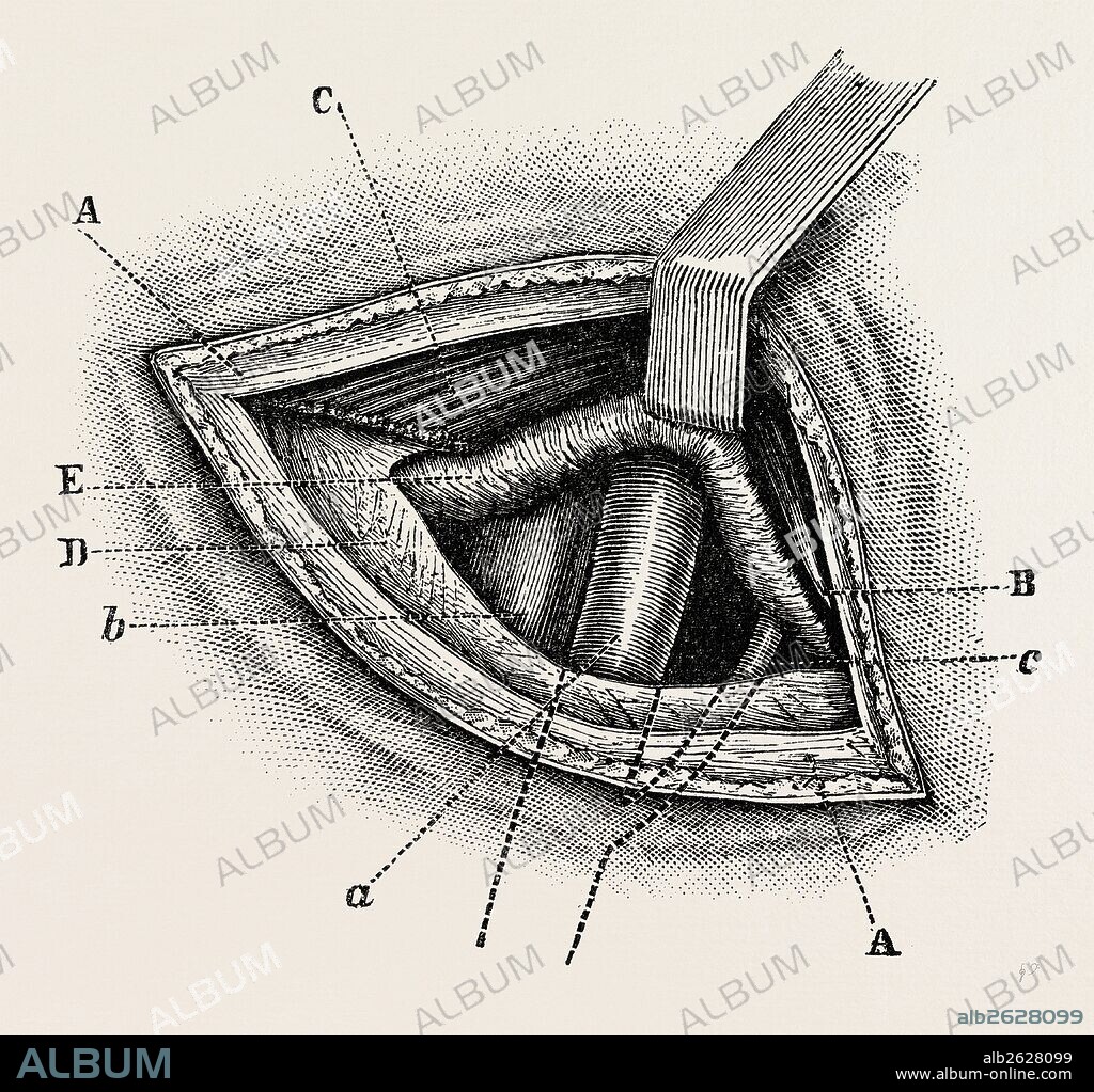 ligature of right external iliac artery, medical equipment, surgical instrument, history of medicine.