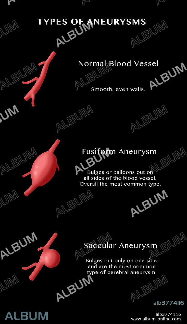 Types of Aneurysms