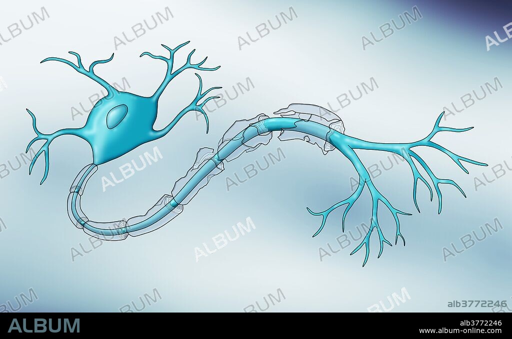 Demyelination. A demyelinating disease is any disease of the nervous system in which the myelin sheath of neurons is damaged.
